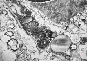 M,71y. | Alzheimer diseaseaccompanied with CADASIL M,71y. | Alzheimer diseaseaccompanied with CADASIL